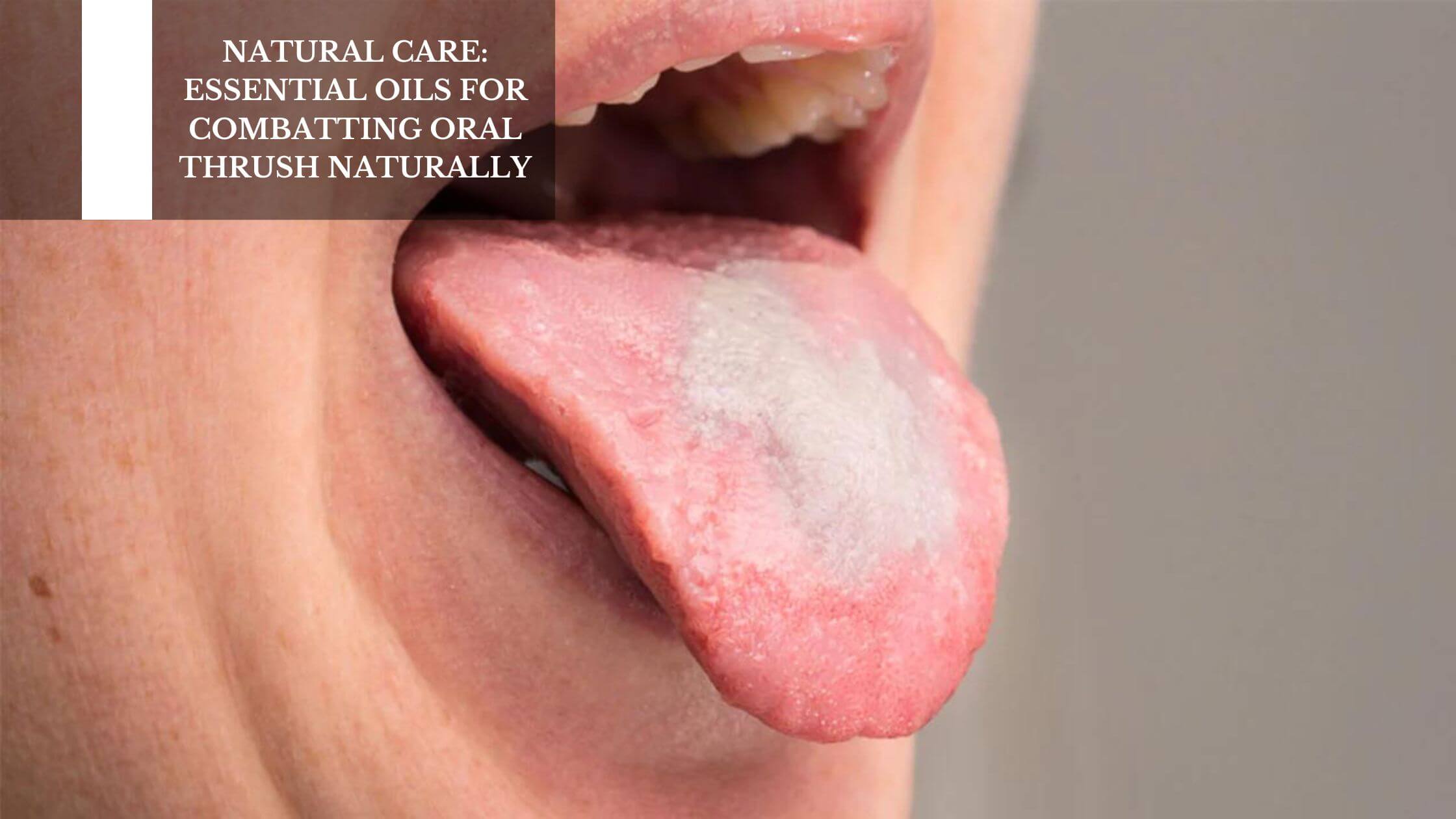 Natural Care Essential Oils For Combatting Oral Thrush Naturally