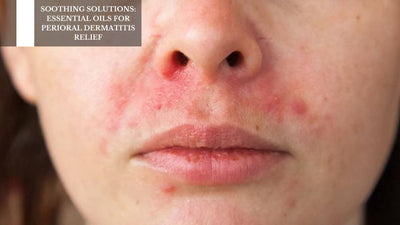 Soothing Solutions: Essential Oils For Perioral Dermatitis Relief