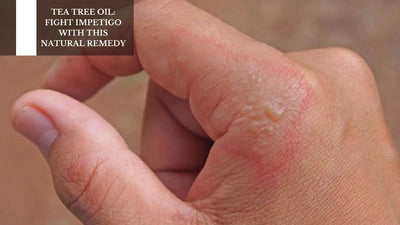 Tea Tree Oil: Fight Impetigo With This Natural Remedy